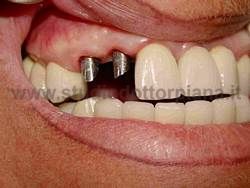 Implantologia dentale estetica