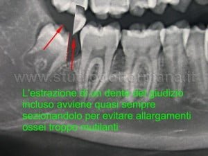 Estrazione ottavo incluso.Un caso reale