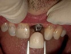 implantologia dentale classica