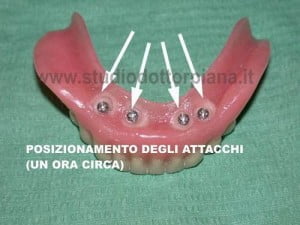 attacchi per i mini impianti dentali