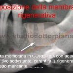 rigenerazione ossea guidata GBR video