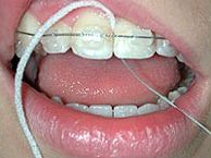 superfloss ortodonzia