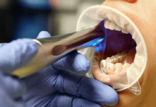 Specillo Dentale A T Doppia Testa Trasparente, 1 Pezzo, Per Odontoiatria, Nuovo