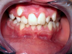 ortodonzia in disallineamento