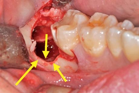 Margine alveolare post estrazione