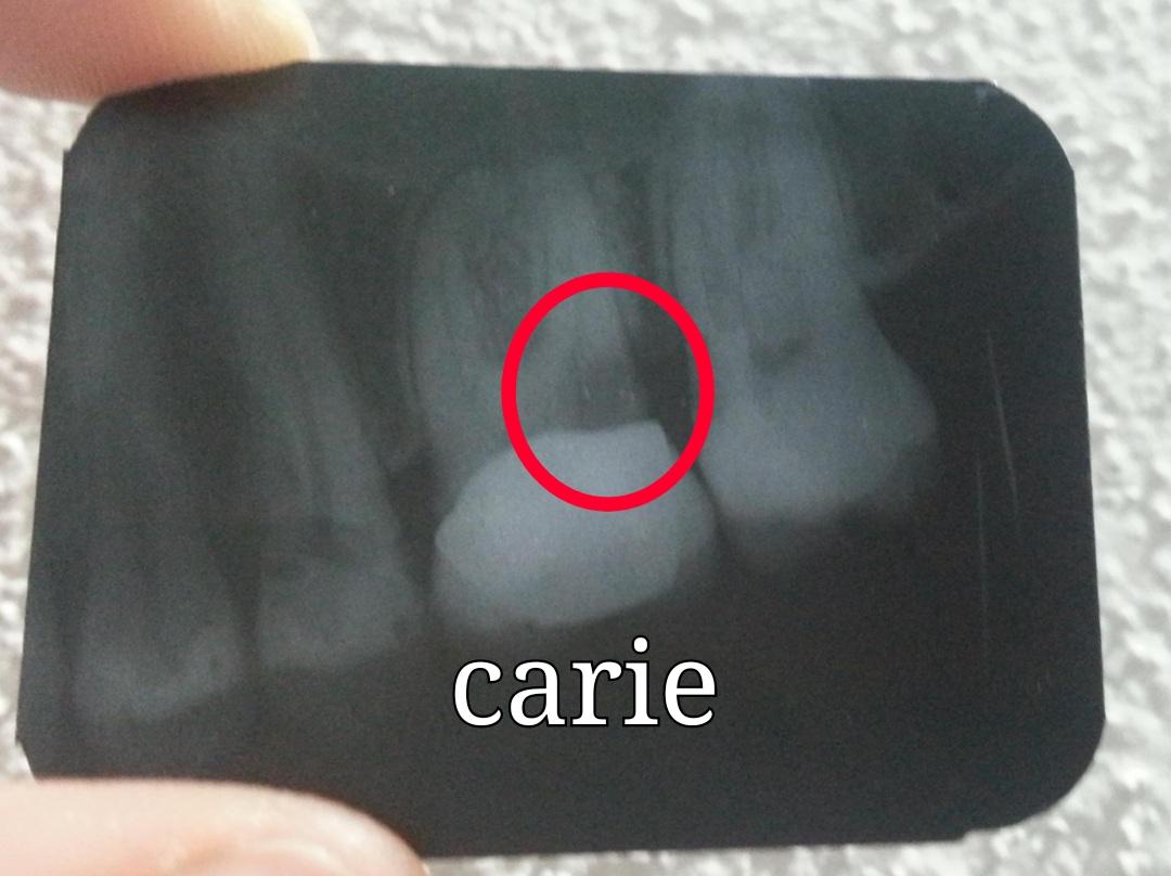 Corona e carie